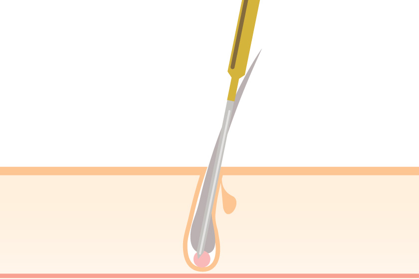 白髪に対応できる脱毛方法とは？