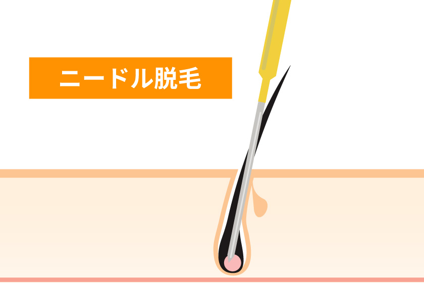 日焼け肌でも施術可能な脱毛方法とは？