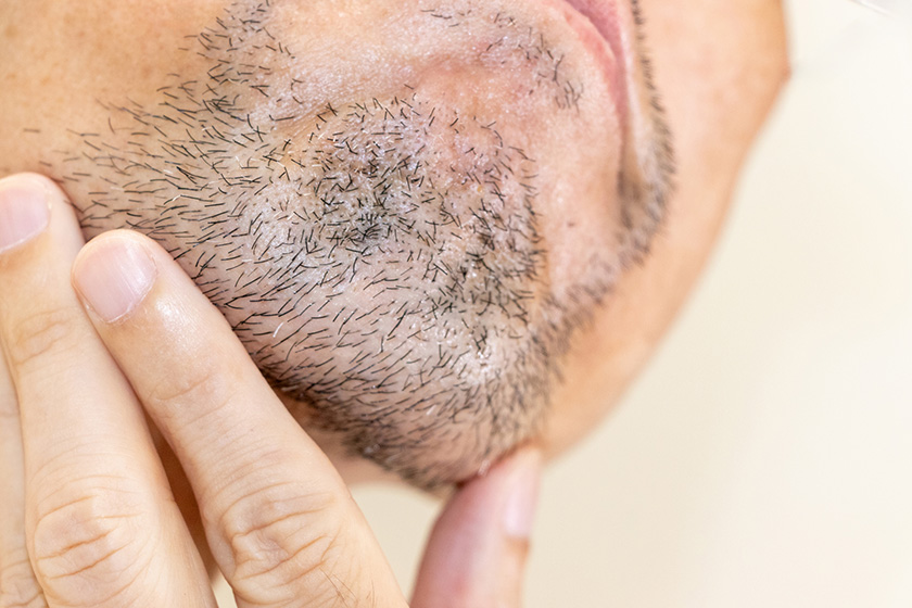 おじさん世代がヒゲ脱毛をすべき理由